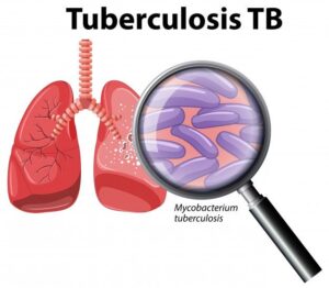Tuberculosis and its Top Homeopathic Medicines